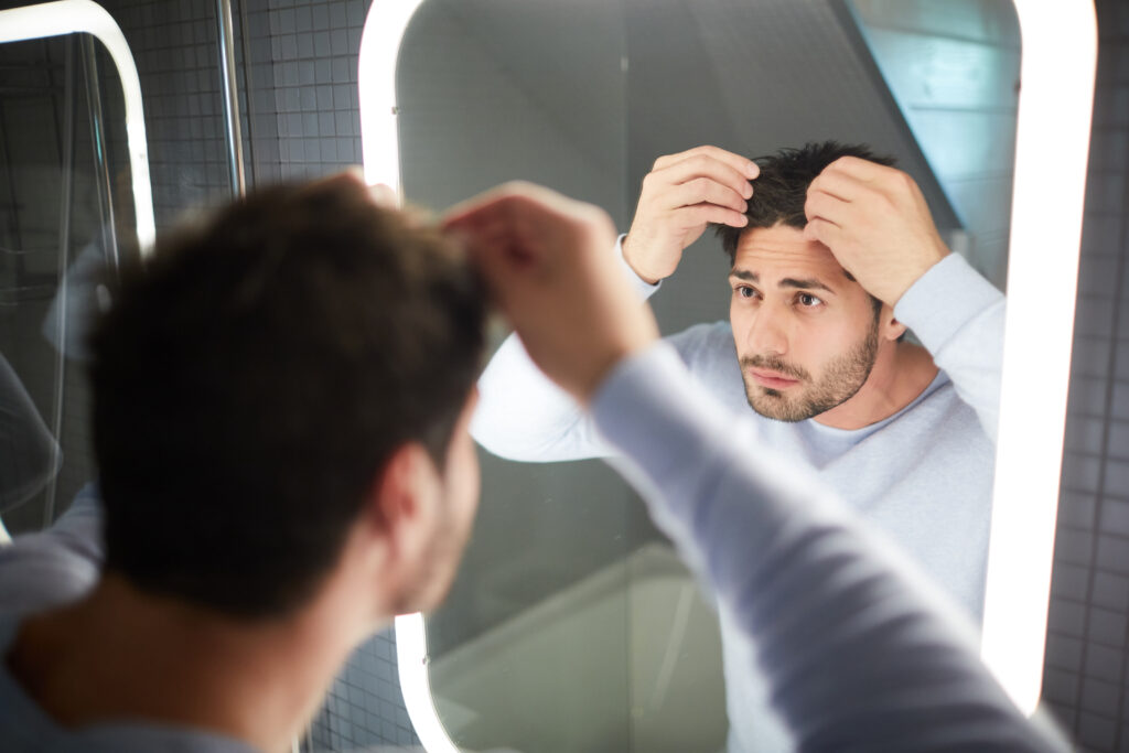 Man experiencing hair loss due to overuse of Dianabol Steroids in Canada